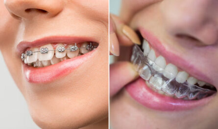 Traditional vs Invisible Braces
