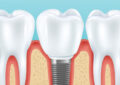 implant