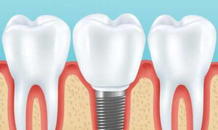 implant