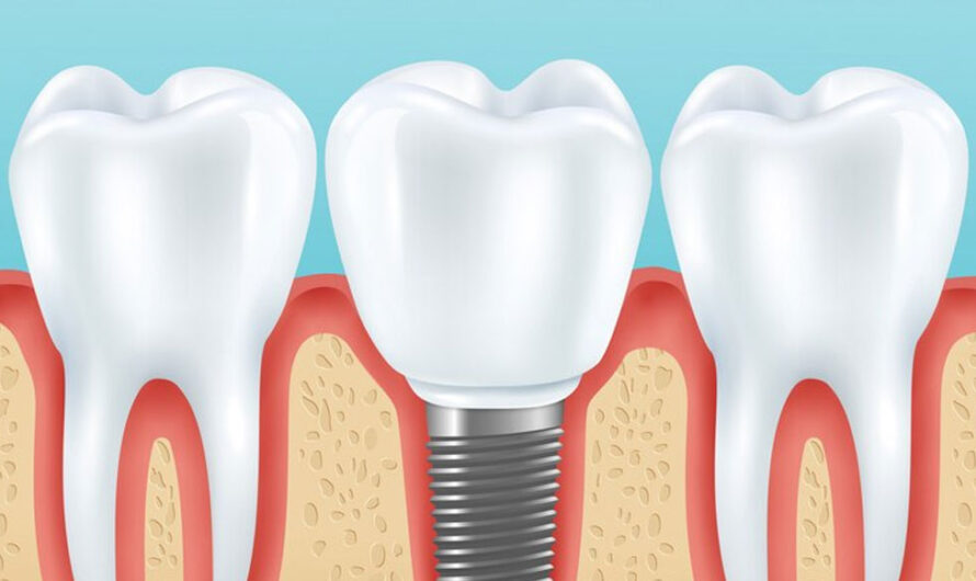 Dental Implant Care: Maximizing Longevity & Health