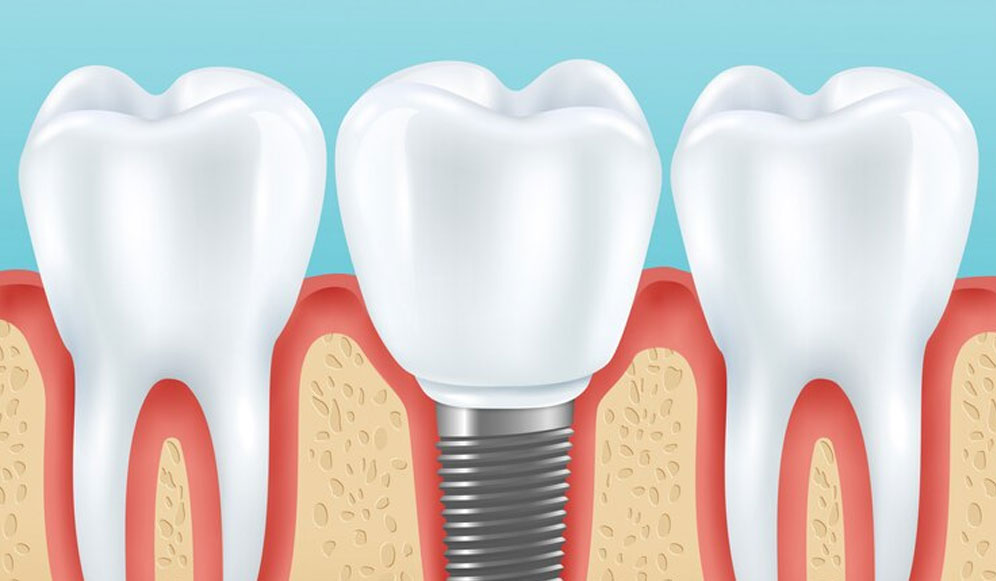 implant