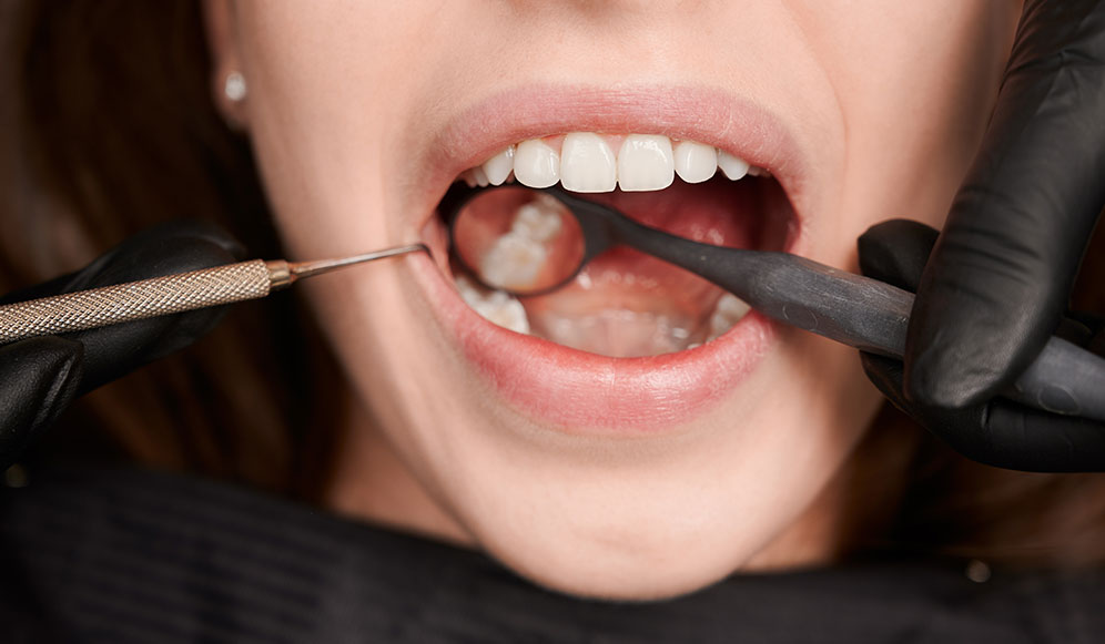 Aesthetic Fillings