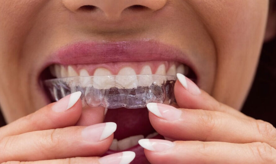 Aligner Therapy: Your Journey to a Straighter Smile in Jogeshwari