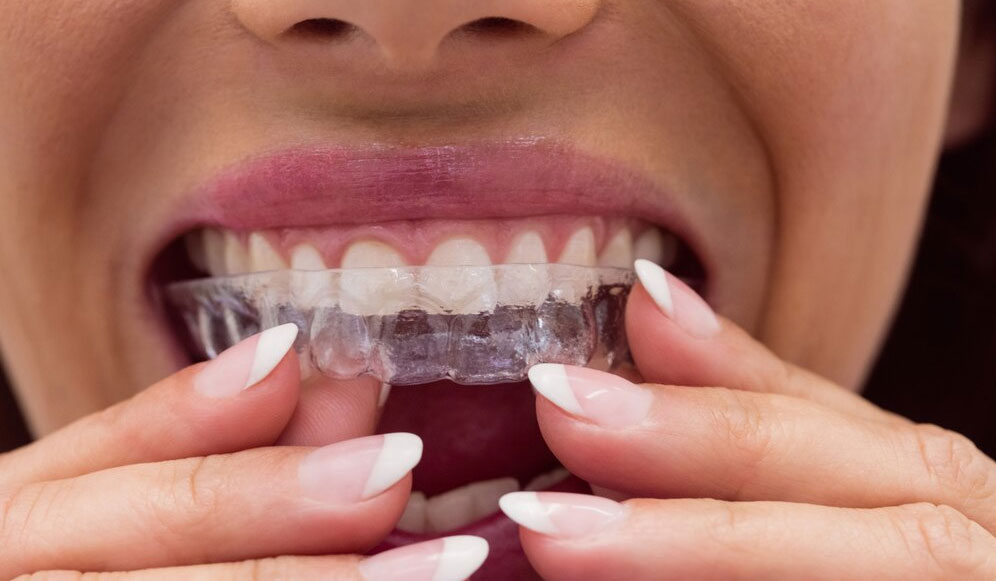 Aligner Therapy
