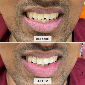 Front Tooth Restoration