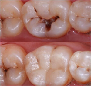 Molar Restoration