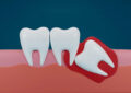 Wisdom Teeth Removal