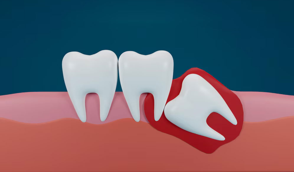 Wisdom Teeth Removal