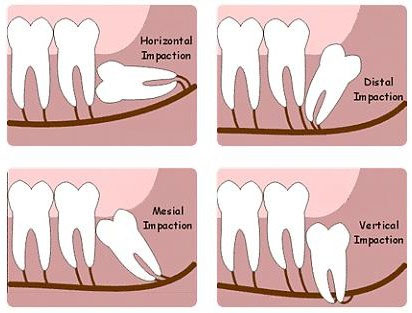 Wisdom Teeth 