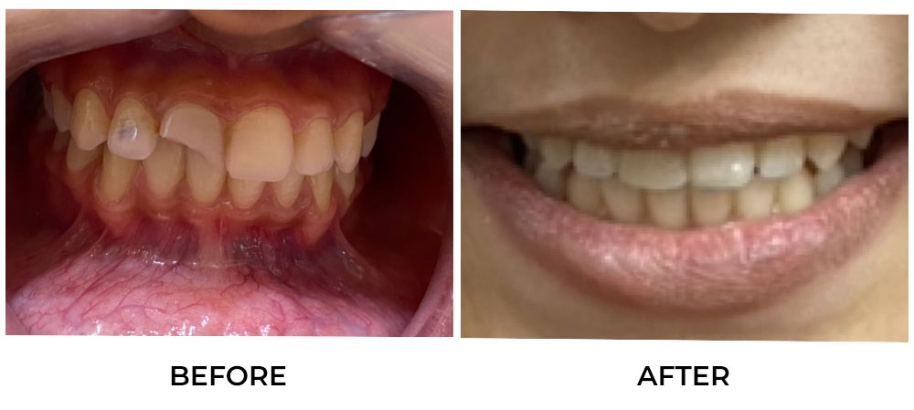 tooth color