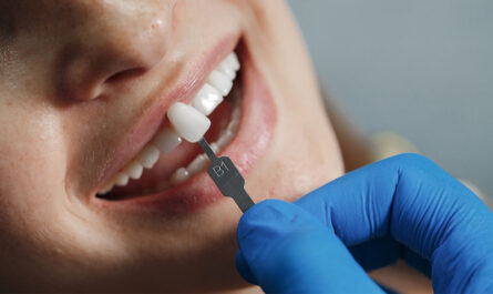 Dental Veneers