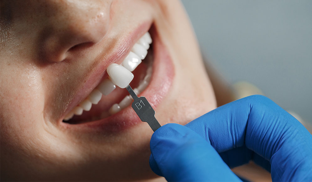 Dental Veneers