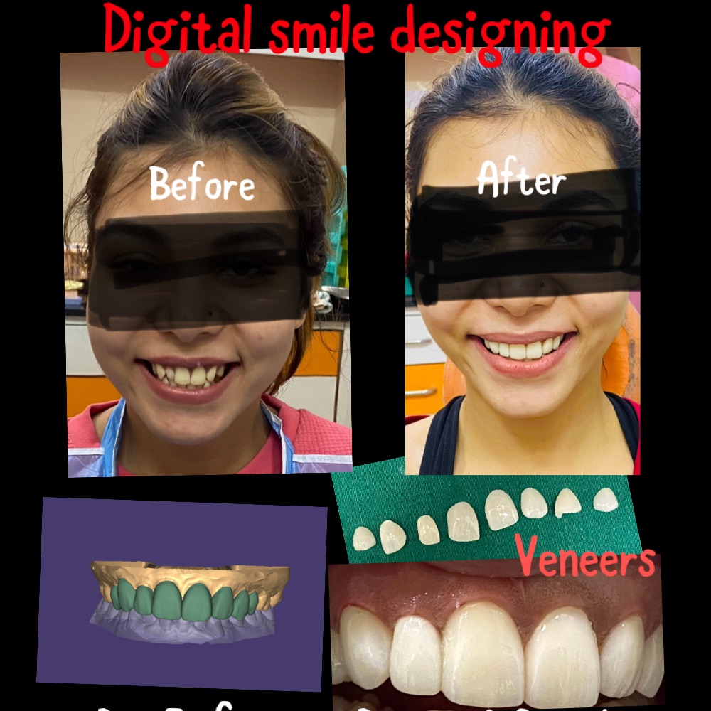 Veneers 