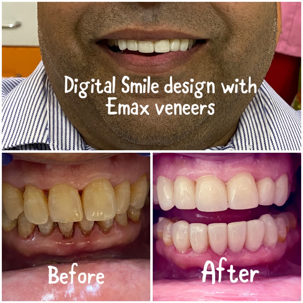 Veneers