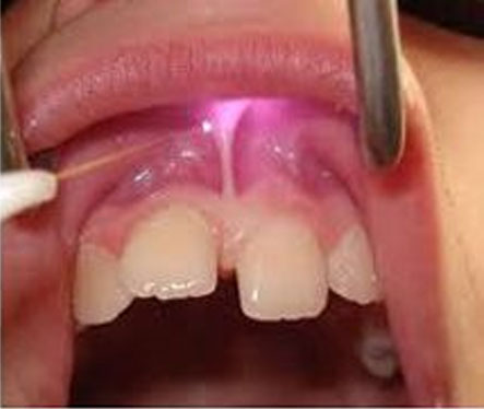 Frenectomy