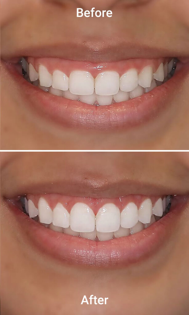 Gum Contouring 