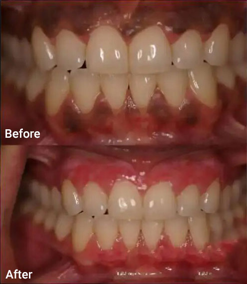 Gum epigmentation