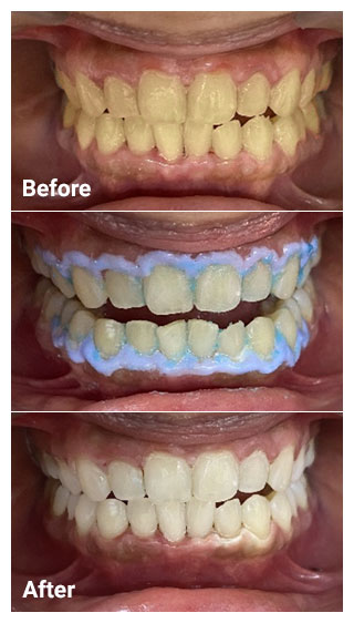 Teeth-Whitening-before-after.