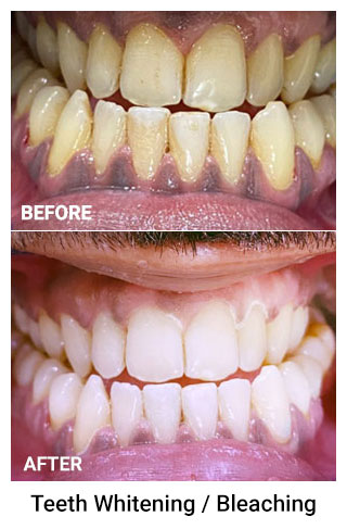 Teeth Whitening Bleaching