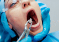 Tooth Extraction
