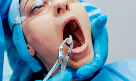 Tooth Extraction