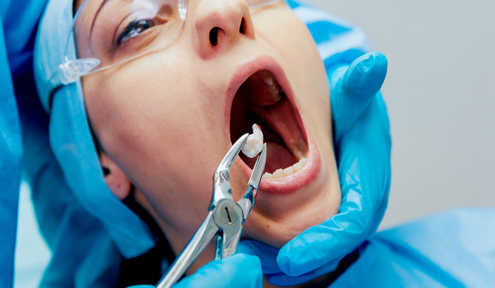 Tooth Extraction