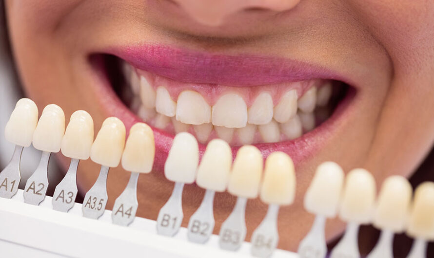 Top 5 Reasons Your Teeth Turn Yellow and How Whitening Helps