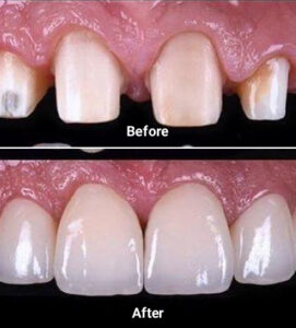Porcelain or ceramic