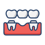 dental bridge