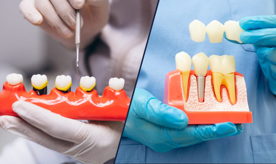 Crowns & Bridges: Simple Solutions for Stronger, Natural-Looking Teeth