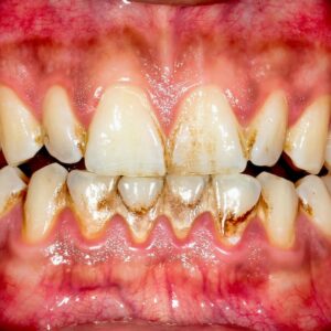 Caffeine Lovers: How Your Daily Coffee is Affecting Your Smile 4 Gum Health