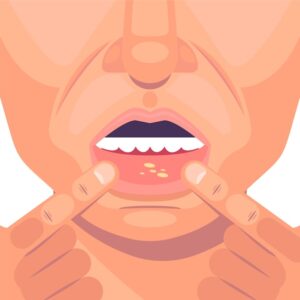 7 Signs You Need to See a Dentist Immediately 6 Unhealed Sores or White Patches