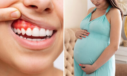 Bleeding Gums During Pregnancy