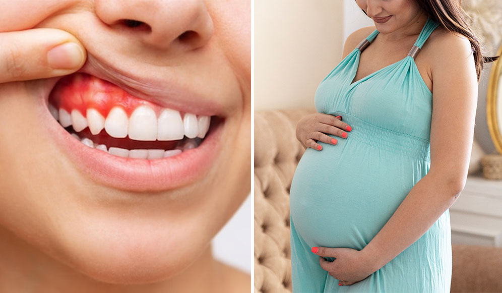 Bleeding Gums During Pregnancy