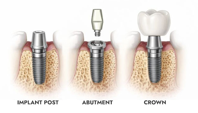 dental implant