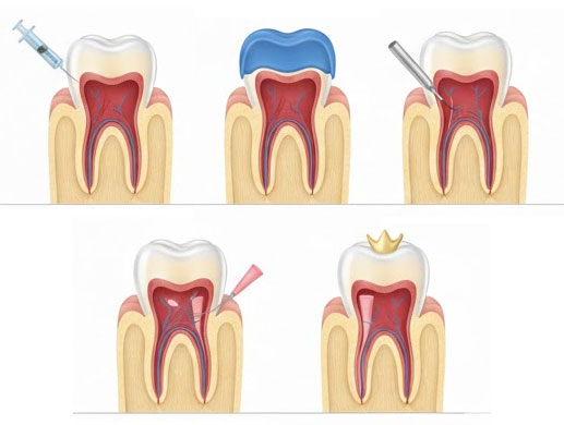 Root Canal Procedure