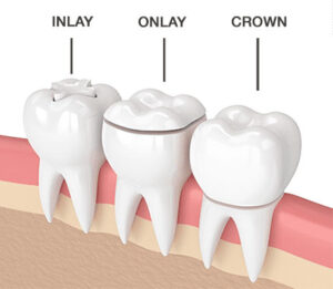 inlays onlays and crowns
