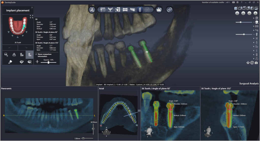 Dental Implant In Jogeshwari West