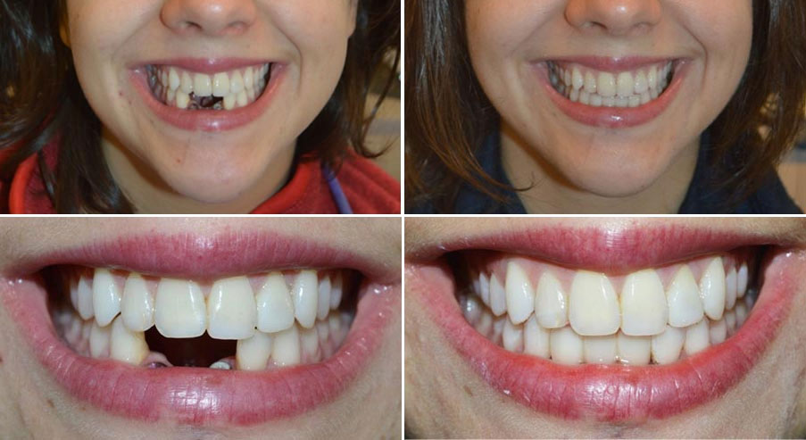 dental implants in Jogeshwari West