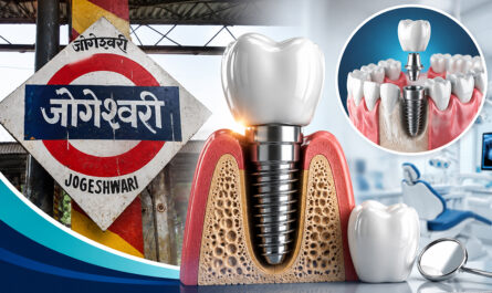 Dental Implants in Jogeshwari