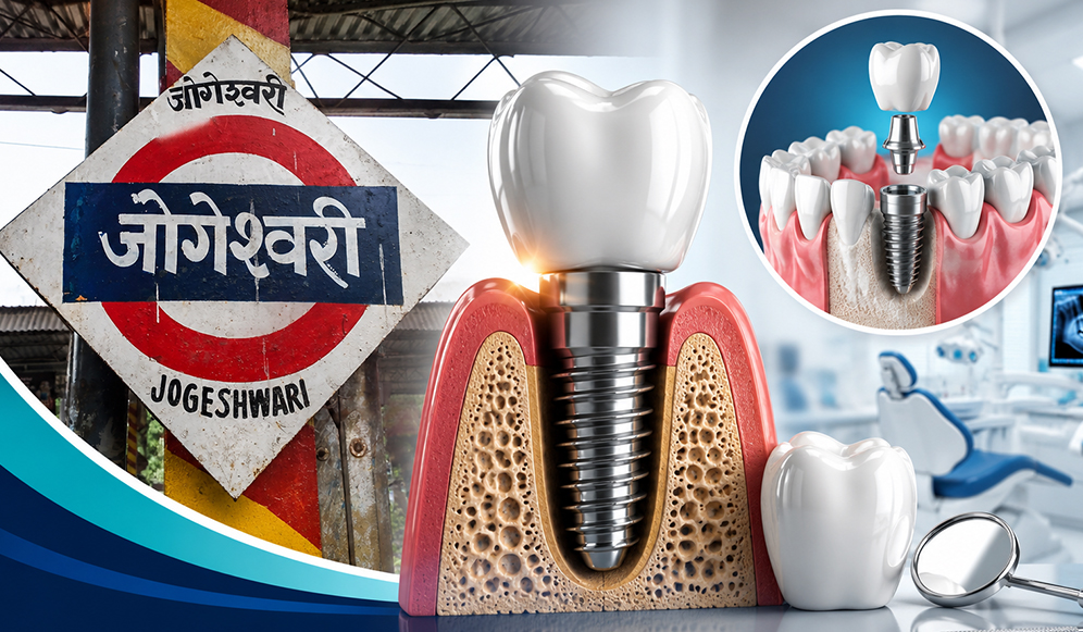 Dental Implants in Jogeshwari