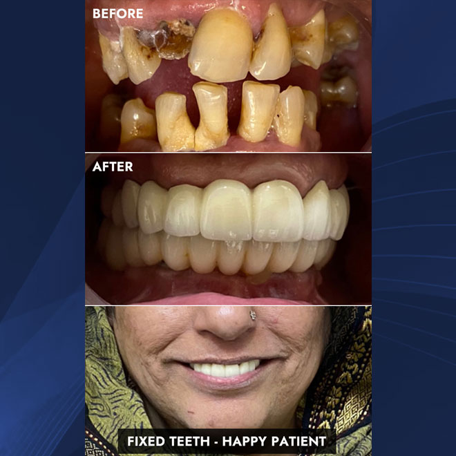 Advantages of Dental Implants