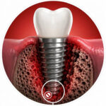 Will Your Body Reject a Dental Implant? Understanding Implant Failure vs. Rejection 2 Failed Osseointegration