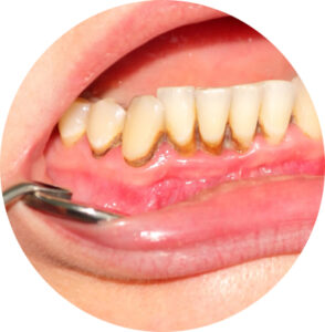 Will Your Body Reject a Dental Implant? Understanding Implant Failure vs. Rejection 4 Poor Oral Hygiene and Infection