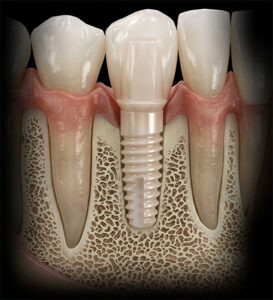 Will Your Body Reject a Dental Implant? Understanding Implant Failure vs. Rejection 7 Zirconia Ceramic Dental Implants