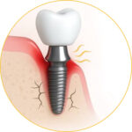 Will Your Body Reject a Dental Implant? Understanding Implant Failure vs. Rejection 6 dental implant Titanium Allergy